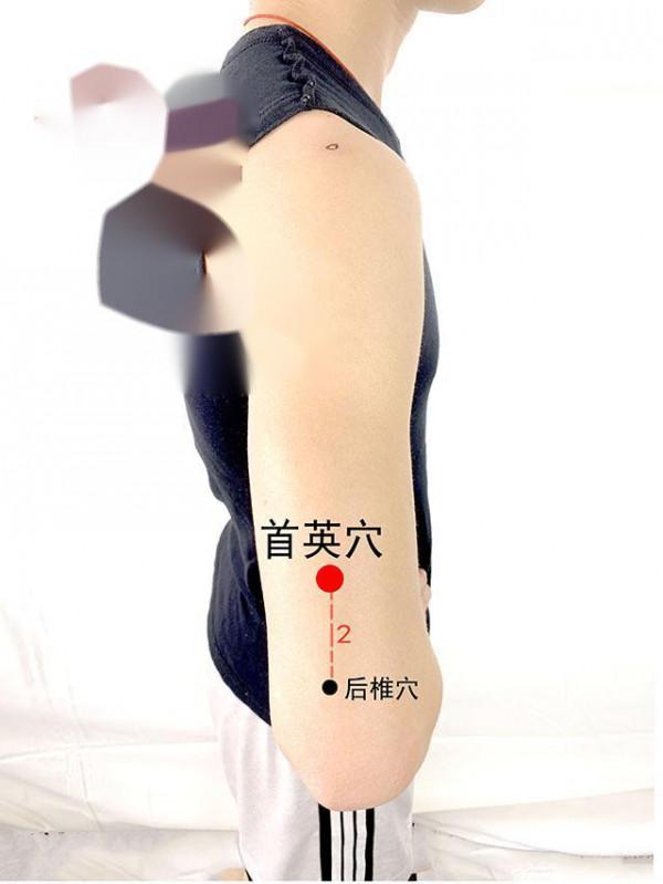 中醫針灸上肢疾病處方6 中醫針灸上肢疾病處方6