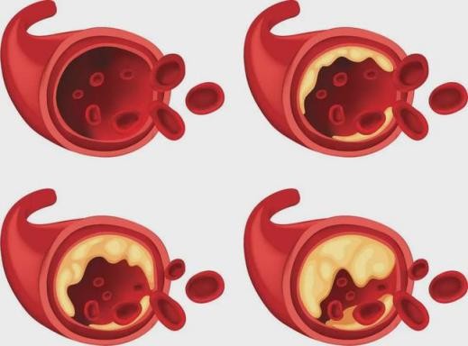 血管鈣化還能補鈣嗎 血管鈣化還能補鈣嗎