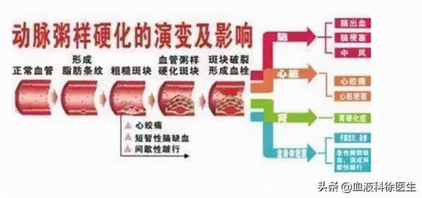 60歲大爺斑塊消失，他長期堅持2個“護血管”方法，行之有效