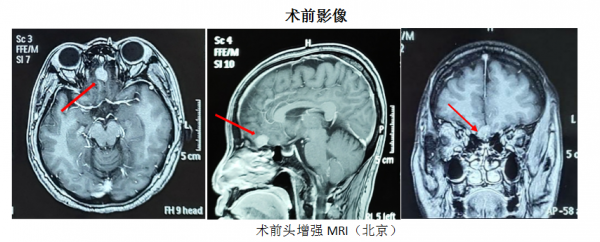 內鏡微創手術&mdash;&mdash;嗅溝腦膜瘤患者的福音