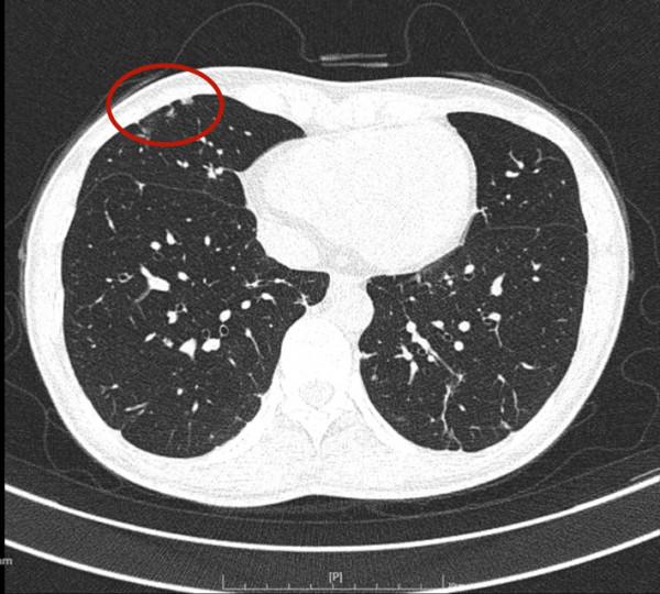 問診分析：兩肺多發實性結節，各科各醫院意見不一，如何是好？