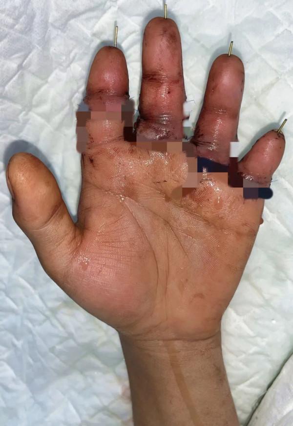 6小時徹夜奮戰保肢成功——北京積水潭醫院手外科完成2022年首例斷肢再植手術