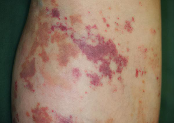 過敏性紫癜的症狀