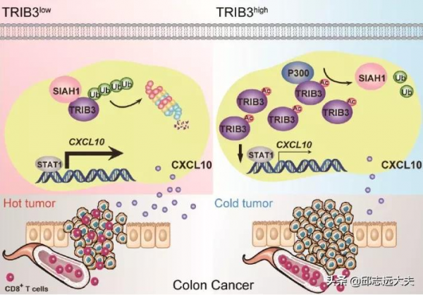 《科學》子刊：北京協和醫院團隊破解腸癌“排斥”T細胞之謎