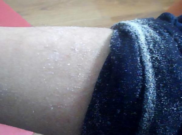 秋冬季節，每次脫褲子，腿上的白色皮屑是怎麼回事兒？