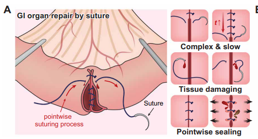 華人團隊發明手術級強力膠帶：快速外科止血，拯救成千上萬生命