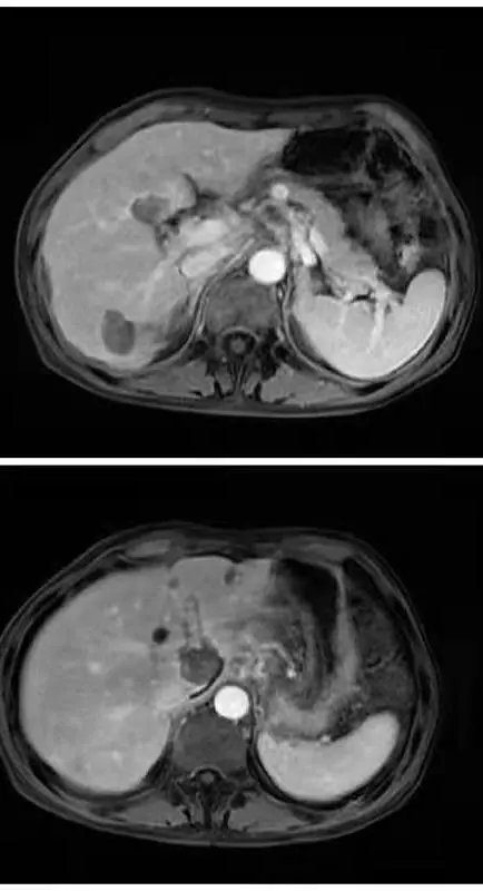 心急如焚!他的癌症很可能復發了 心急如焚!他的癌症很可能復發了