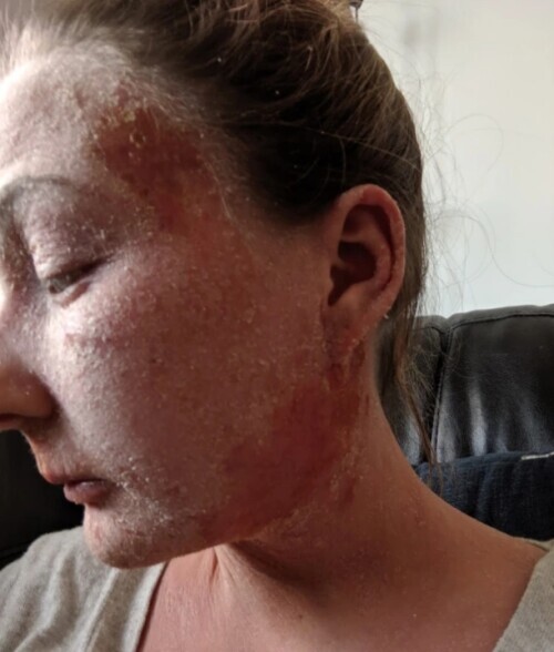 女子使用類固醇霜治療溼疹 面板脫落滲液 女子使用類固醇霜治療溼疹 面板脫落滲液