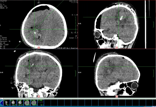 7歲小學生深夜突發腦出血,生死一線!家長疑惑:老年病為何小孩會得?醫生術中找出原因 7歲小學生深夜突發腦出血,生死一線!家長疑惑:老年病為何小孩會得?醫生術中找出原因