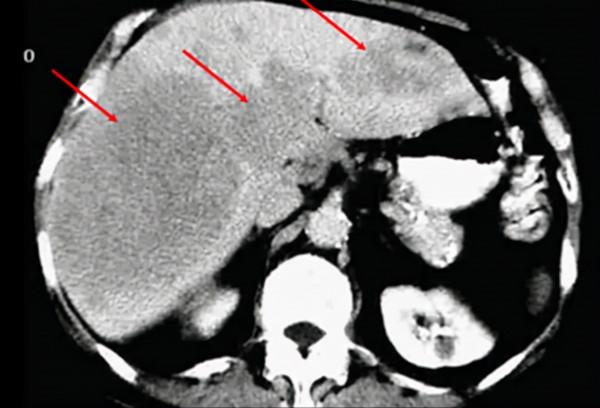 還沉迷於酒的世界嗎？天天喝酒有多可怕，快看看