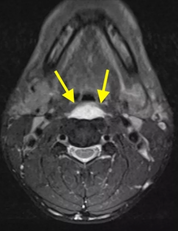 頸椎少見的3種鈣化性疾病 頸椎少見的3種鈣化性疾病