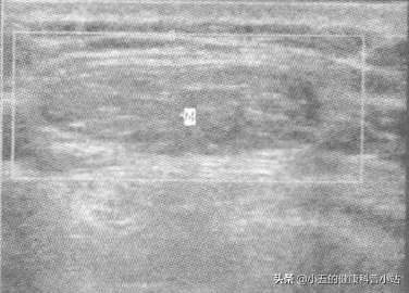 什麼是脂肪瘤，它會癌變嗎，我們應該怎麼正確治療脂肪瘤