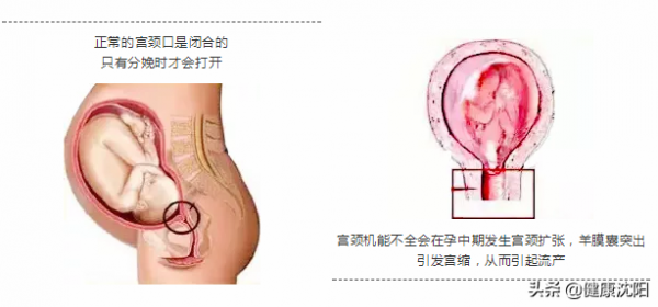 健康科普堂 | 早產有先兆,孕婦應知道,超聲可預測,醫生來治療 健康科普堂 | 早產有先兆,孕婦應知道,超聲可預測,醫生來治療