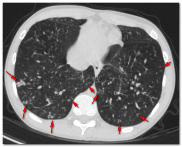 鼻子問題帶出肺病,17歲小夥咳嗽8年,氣管鏡吸出“一斤痰” 鼻子問題帶出肺病,17歲小夥咳嗽8年,氣管鏡吸出“一斤痰”