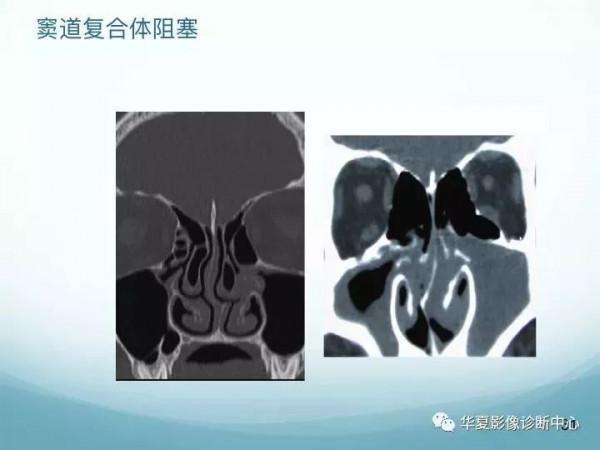 頭頸五官CT斷層解剖圖及常見病影像診斷