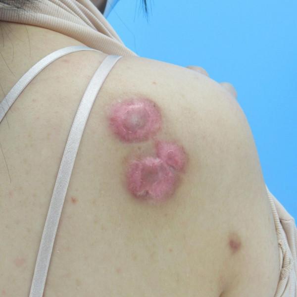 瘢痕疙瘩患者日常護理有哪些? 瘢痕疙瘩患者日常護理有哪些?