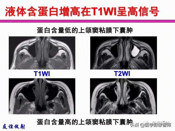 臨床MRI訊號分析基礎：常規序列及DWI序列