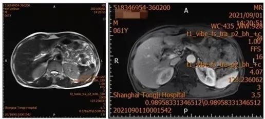 同濟大學附屬同濟醫院普通外科完成全腔鏡下中段胰腺腫瘤切除術