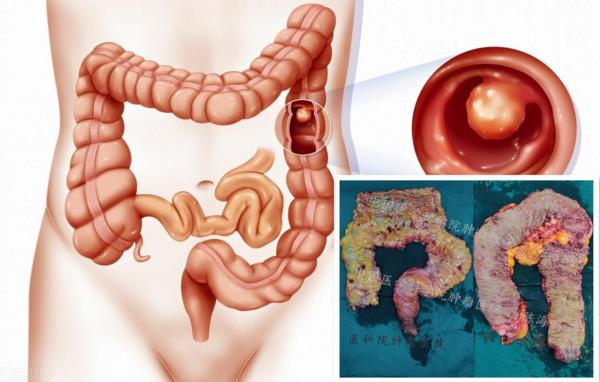 腸道內密密麻麻的息肉咋回事?一個個切嗎? 腸道內密密麻麻的息肉咋回事?一個個切嗎?