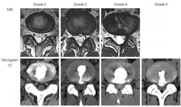 椎間盤源性腰痛 (discogenic low back pain) 椎間盤源性腰痛 (discogenic low back pain)