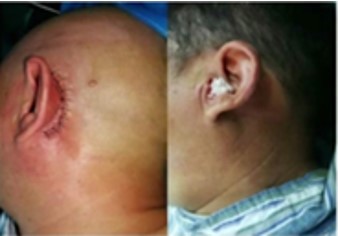 耳朵里長了個小珍珠 耳朵里長了個小珍珠