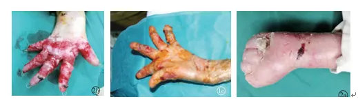 幹細胞拯救不美麗的&OpenCurlyDoubleQuote;蝴蝶病&rdquo;，使面板長期保持穩定性