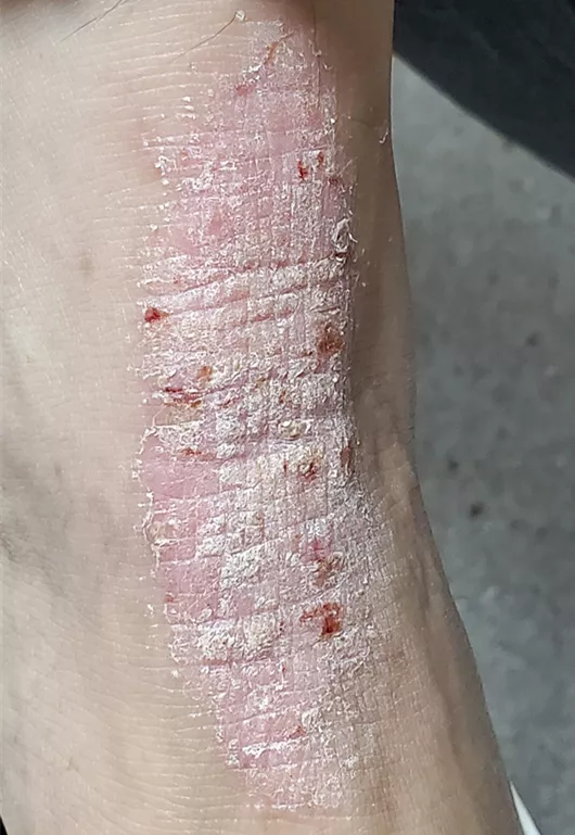 越癢越撓、越撓越癢、越撓越急?神經性皮炎犯了,先別瞎搔抓 越癢越撓、越撓越癢、越撓越急?神經性皮炎犯了,先別瞎搔抓