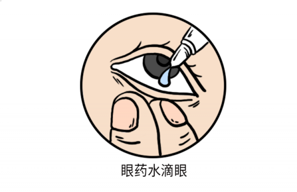 16歲高中生滴激素類眼藥水半年，引發青光眼視力降到0&period;1