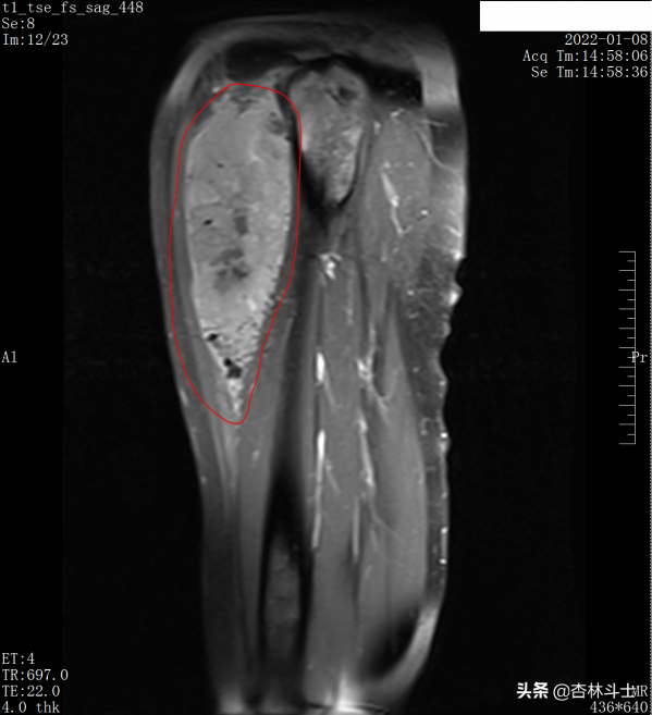中年女性，兩年連續多次預警不重視，再次檢查發現腫瘤已是晚期了