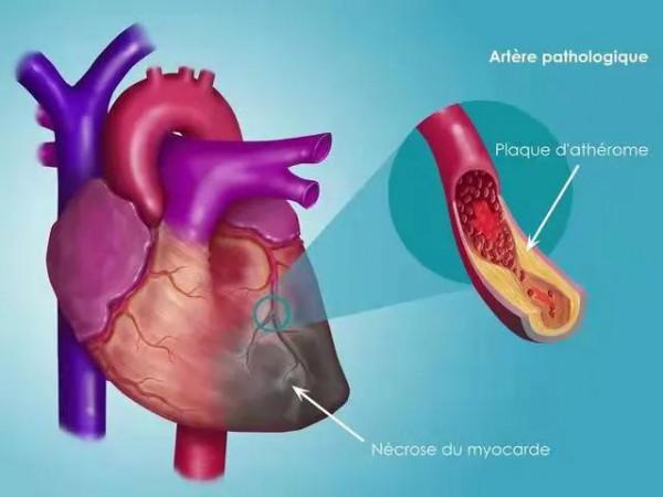 心血管狹窄,怕心梗吃阿司匹林或他汀類藥物,看醫生的建議 心血管狹窄,怕心梗吃阿司匹林或他汀類藥物,看醫生的建議