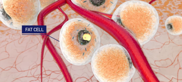 注入脂肪堆積物的新型水凝膠可以從內部對抗肥胖症