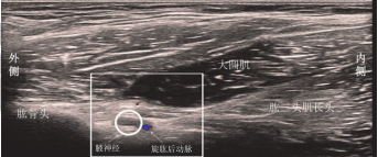 超聲引導下腋神經阻滯的研究進展