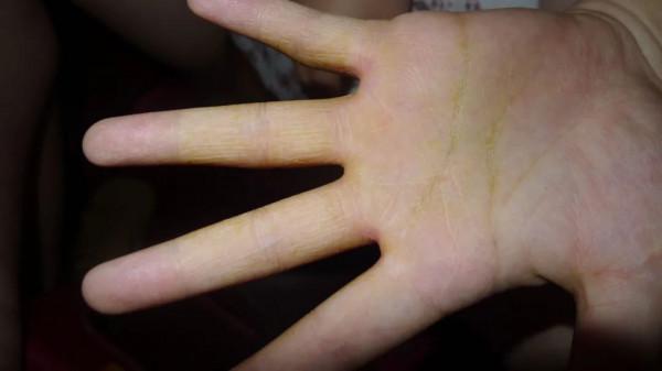 身體出現這4個症狀，說明肝病來臨，如何預防？醫生：做好這3點