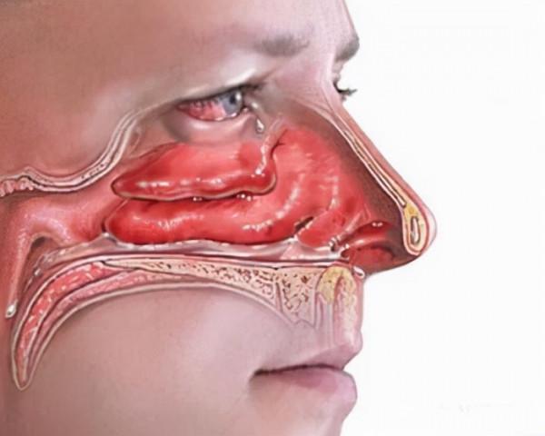 不明頭痛怎麼辦？不僅要看內科醫生，也別忘了到耳鼻喉科看一看