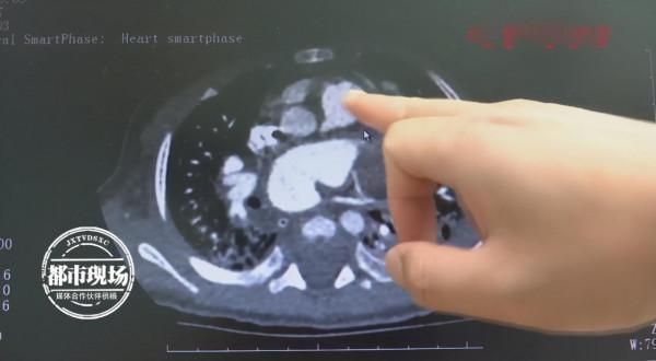 5月大嬰兒心臟竟有成人般大小,醫生:血管搭錯了,很致命 5月大嬰兒心臟竟有成人般大小,醫生:血管搭錯了,很致命