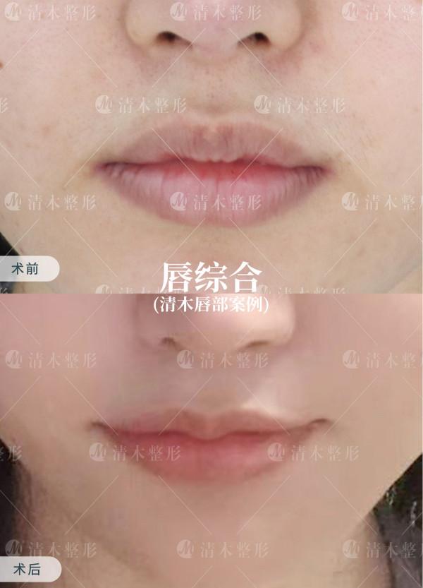 上唇m唇＋嘴角上揚