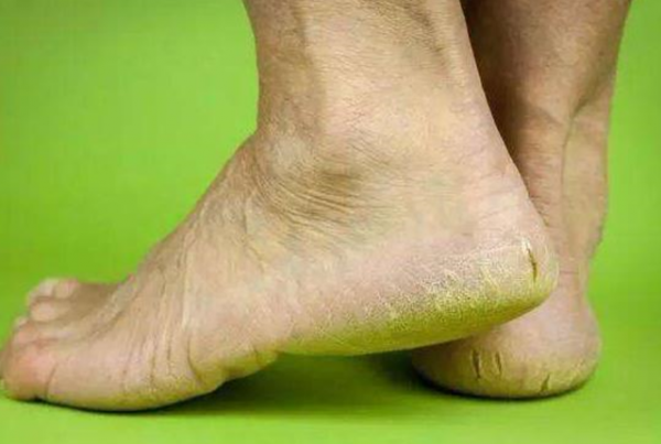 腳後跟乾裂，小腿長&OpenCurlyDoubleQuote;魚鱗&rdquo;，或並非是面板缺水所致