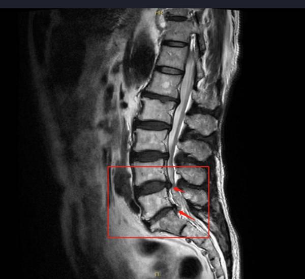 腰疼15年誤作“腰突症”治，南郊醫院確診“椎管狹窄”微創解除
