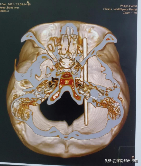京豫專家聯手，取出男孩顱內一根筷子