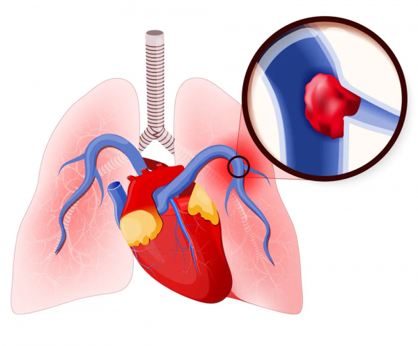 血管堵了是什麼感覺？如何發現、預防？