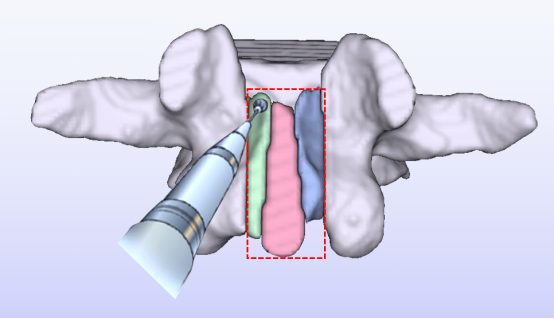 中國醫大一院新術式為腰椎管狹窄症患者解病痛