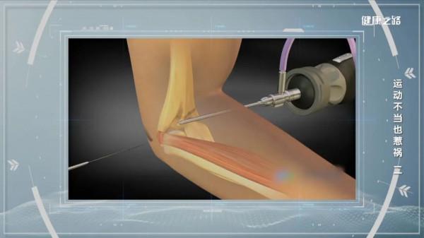 運動姿勢、球拍選擇，保護肘關節，從關注細節開始