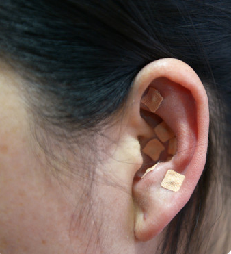 耳穴埋豆療法,減輕術後疼痛 耳穴埋豆療法,減輕術後疼痛