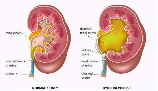 鹽吃多了對身體不好！餐桌上的5種“高鹽食物”，勸你和家人少吃