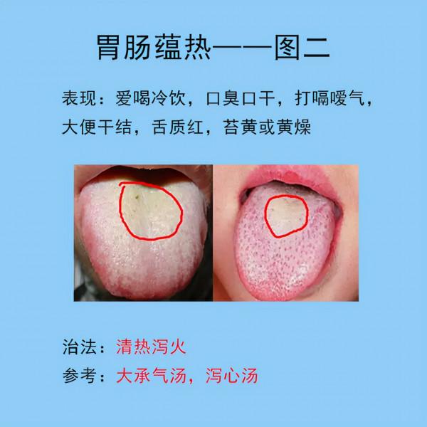 脾胃常見的10種舌象,以及臨床表現,後面帶解決方法 脾胃常見的10種舌象,以及臨床表現,後面帶解決方法