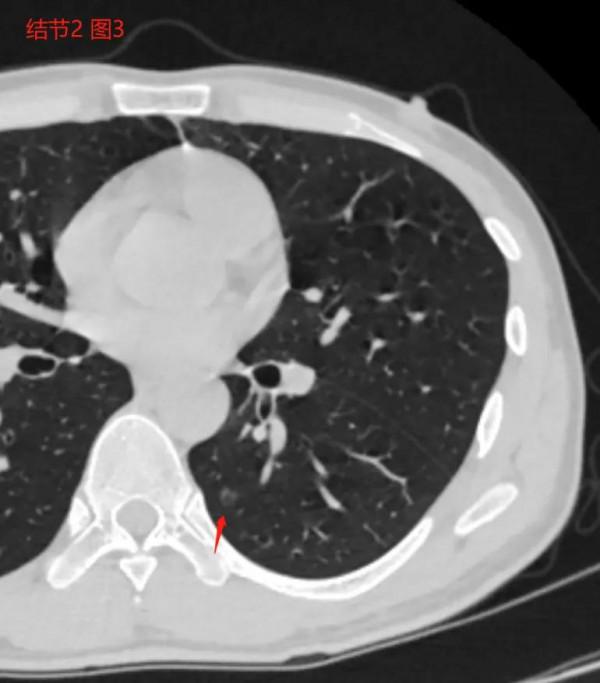 醫生同行患8mm多發混合磨玻璃結節，我判斷：傾向良性