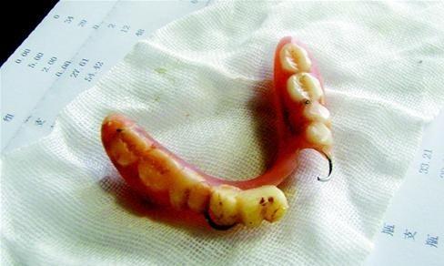 專家提醒！戴假牙的4大禁忌，很多人經常做