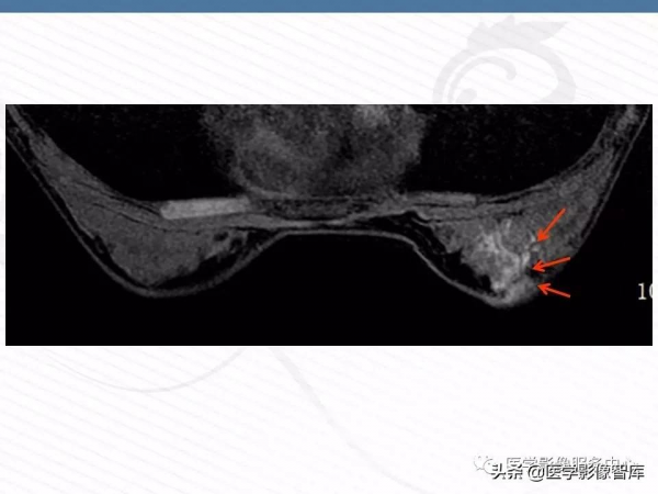 乳腺T2WI高訊號腫瘤病變的診斷思路 乳腺T2WI高訊號腫瘤病變的診斷思路