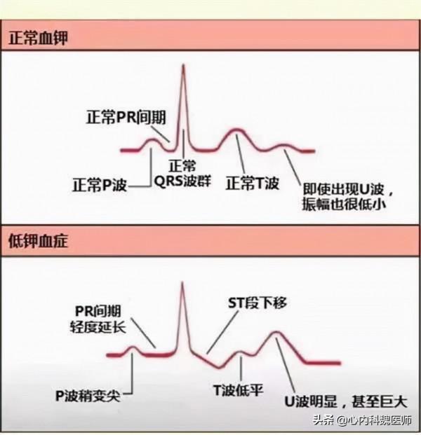 吃降壓藥可能導致缺鉀,比缺鈣更危險!留意身體3大症狀 吃降壓藥可能導致缺鉀,比缺鈣更危險!留意身體3大症狀