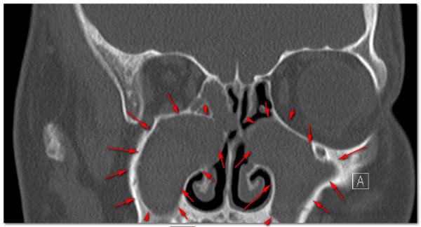 鼻子問題帶出肺病,17歲小夥咳嗽8年,氣管鏡吸出“一斤痰” 鼻子問題帶出肺病,17歲小夥咳嗽8年,氣管鏡吸出“一斤痰”